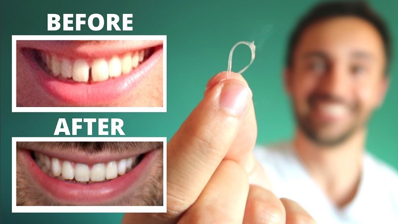 Tooth Gap Treatment